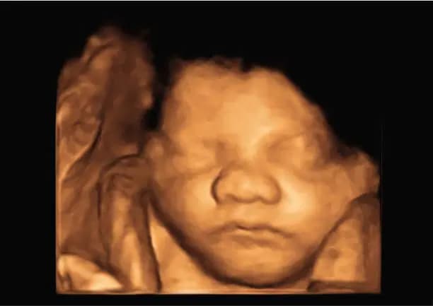 3D ultrasound scan